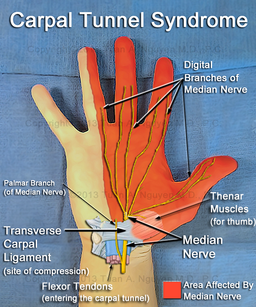 About Carpal Tunnel Syndrome - Lake Oswego Hand Surgery - Portland, Oregon