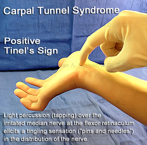 Carpal Tunnel Syndrome - Portland and Lake Oswego Surgery - Tinel's diagnostic Sign for median nerve irritation